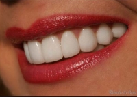 After picture: woman with porcelain veneers smiling