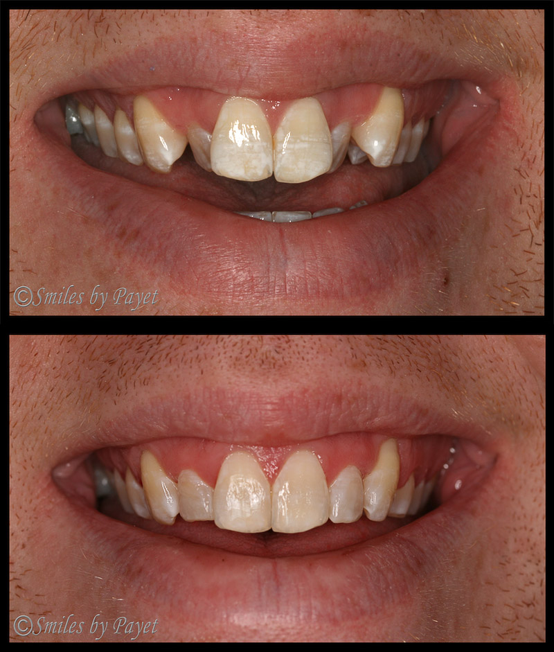 Four (4) Month Braces - Very crowded top front teeth made straight in only 4 months by Charlotte cosmetic dentist Dr. Charles Payet Crowded front teeth straightened with Six (6) Month Braces