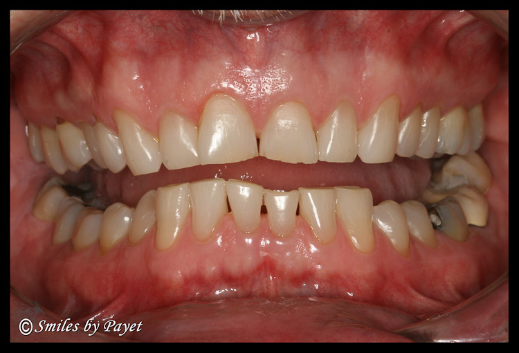 Teeth worn down by grinding (bruxism) Teeth damaged by grinding and clenching - uneven, jagged, sharp. Dr. Payet, a TMJ dentist in Charlotte can help.