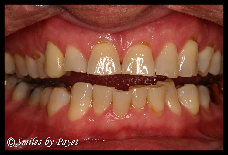 Teeth damaged by grinding & clenching