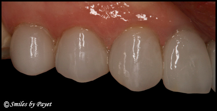 Which Porcelain Veneer is a CEREC? A Porcelain Dental Veneer made by Charlotte dentist Dr. Payet with the CEREC CAD/CAM system.