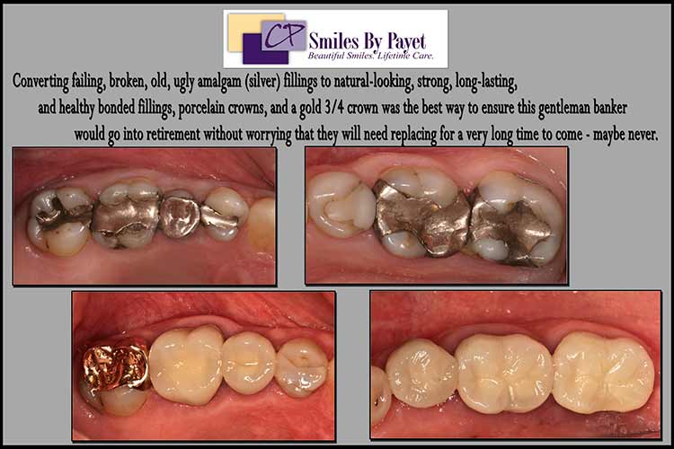 replacing-old-silver-fillings-new-crowns Broken silver fillings with cavities, fixed with porcelain dental crowns, a gold dental crown