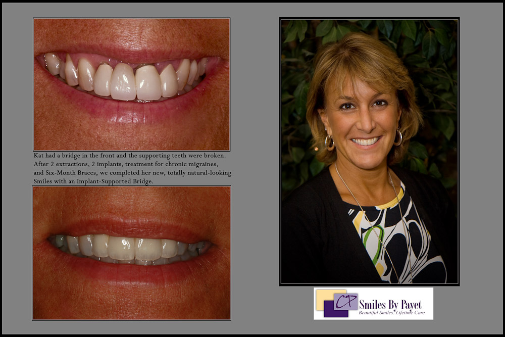 Smile Makeover in Charlotte NC with Dental Implants and a Bridge