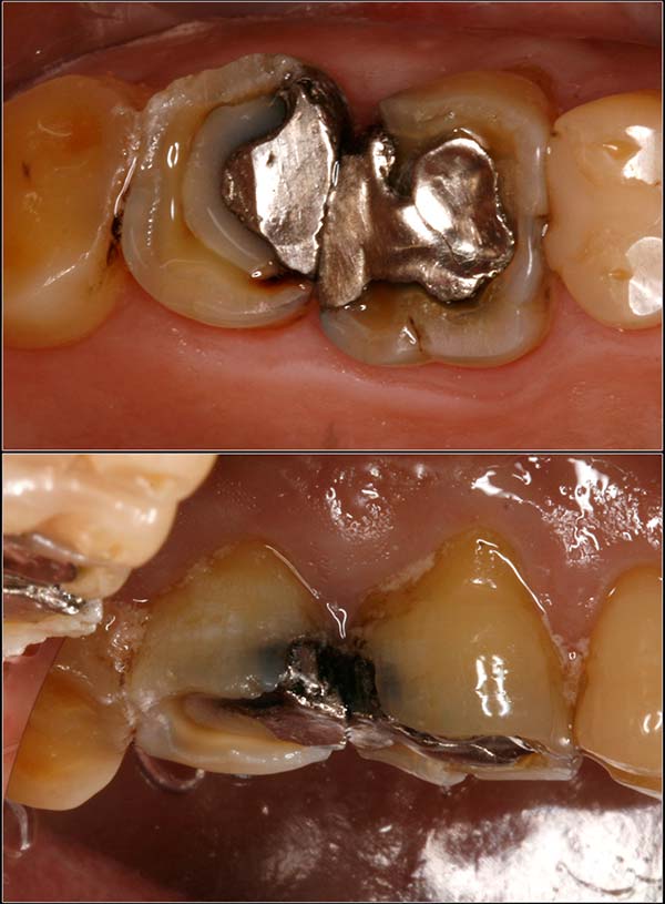 Dental Insurance doesn't always cover needed treatment Dental insurance not covering crowns for decayed and broken teeth