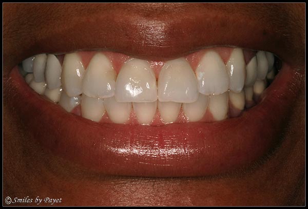 gummy-smile-after Fixing a Gummy Smile with a Gum Lift, or periodontal plastic surgery - AFTER