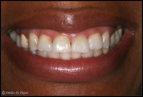 gummy-smile-before Fixing a Gummy Smile with a Gum Lift, or periodontal plastic surgery - Before