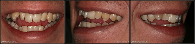 Six-Month Adult Braces Case #1 A Six-Month Braces case to straighten crooked teeth in Charlotte
