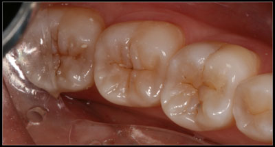 Minimally Invasive Dentistry - BEFORE Teeth after cavities were cleaned out, really small size possible because of the dental microscope.
