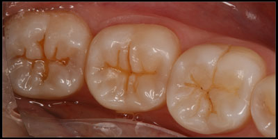 Minimally Invasive Dentistry - DURING Teeth after small cavities were cleaned out with very small preps, possible because of the dental microscope.