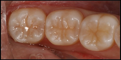 Minimally Invasive Dentistry example - AFTER Teeth after very small tooth-colored fillings were done, possible because of the dental microscope.
