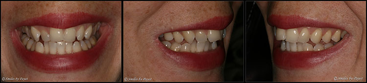 Another Six-Month Smiles Adult Braces case Example Patient #2 of Six Month Adult Braces with Dr. Payet in Charlotte NC.