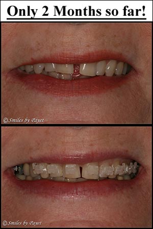 Closing the gap between front teeth with 6-Month Braces Closing the gap between front teeth with 6-Month Braces