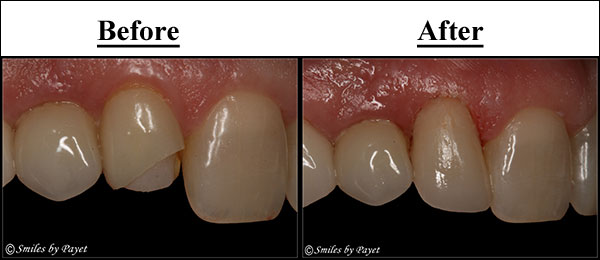 CEREC porcelain dental veneer Charlotte cosmetic dentist Dr. Charles Payet makes porcelain dental veneers in 1 appointment with CEREC