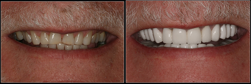 Smile Reconstruction with Porcelain Crowns