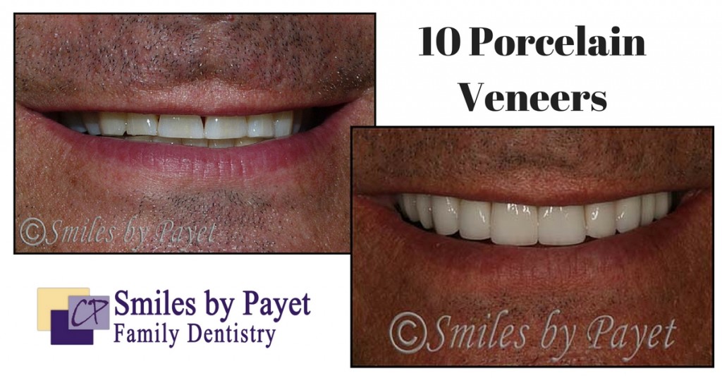 charlotte cosmetic dentistry with 10 porcelain veneers