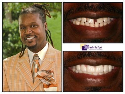 Charlotte cosmetic dentist porcelain veneers