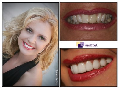 porcelain veneers by Charlotte cosmetic dentist