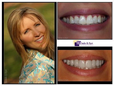 8 porcelain veneers charlotte cosmetic dentist