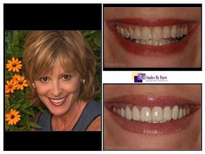 20 porcelain veneers charlotte cosmetic dentist