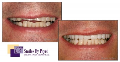 8 porcelain veneers before-after