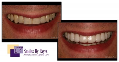 8 porcelain veneers, cosmetic dentistry charlotte nc