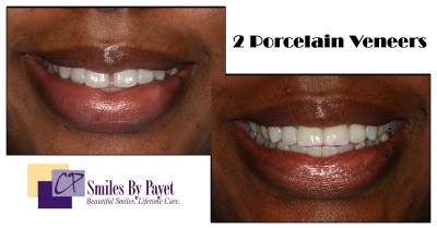 2 porcelain veneers to close a gap between front teeth