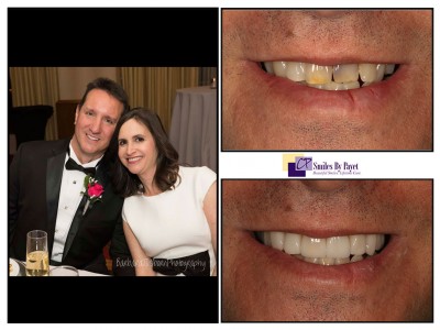 9 porcelain veneers and crowns, cosmetic dentistry charlotte nc