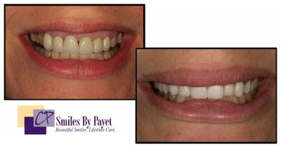 10 porcelain crowns to replace old crowns