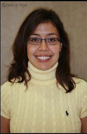 Invisible Six Month Braces Charlotte dentist