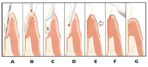 Laser Gum Surgery alternative Charlotte