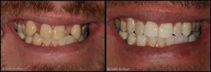 Straight teeth with Six Month Braces by Charlotte dentist