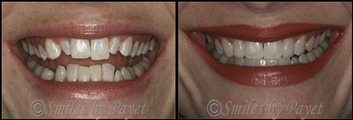 Charlotte Matthews Pineville Six Month Braces