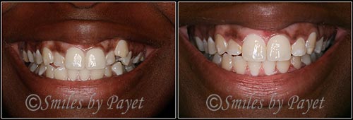 Six Month Braces dentist Charlotte