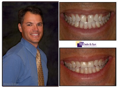 2 porcelain veneers charlotte cosmetic dentistry