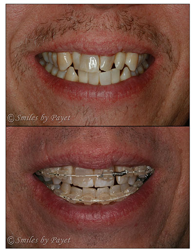 Pictures of a Six-Month Braces case in progress This patient is 44yo and chose Six Month Braces with Charlotte cosmetic dentist to give him a straight smile with six-month braces.