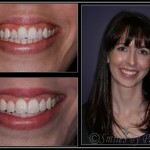 Woman's smile before and after Six Month Braces