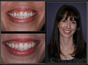 Phaedra chose Six-Month Braces for her Cosmetic Dentistry with Charlotte dentist Dr. Payet