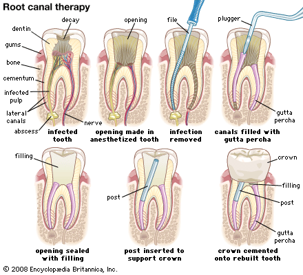 What a Root Canal Looks Like Pictures showing how a dental root canal is done.