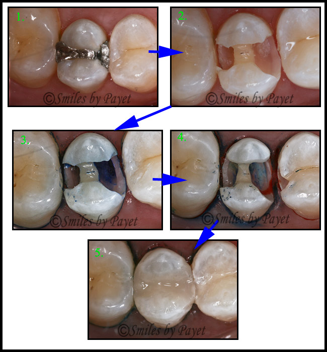 composite Picture sequence showing an old silver amalgam dental filling with a deep but painless cavity, being replaced by a bonded, tooth-colored composite filling.