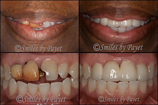 Charlotte dentist Dr. Payet and cosmetic dentistry with a porcelain bridge and crown.