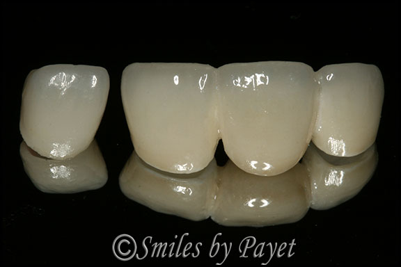 Picture of porcelain dental bridge and crown by Charlotte cosmetic dentist Dr. Payet