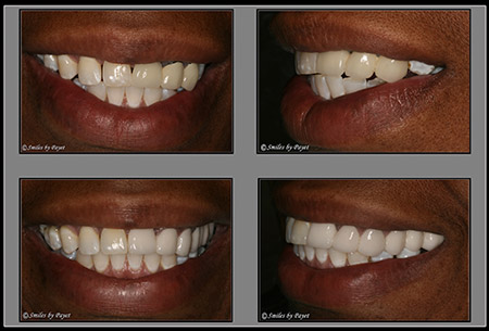 Woman's smile before and after all-ceramic dental bridges