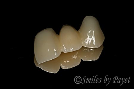 dental-bridge-before-after-3