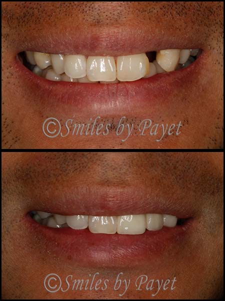 dental-bridge-before-after-4