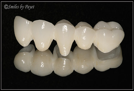 Picture of dental bridge labwork