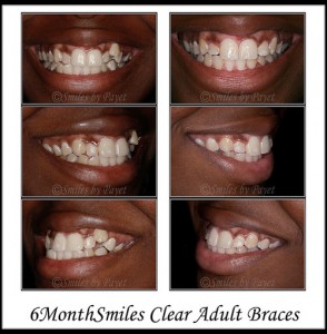 Straight teeth in just 7 months by 6MonthSmiles invisible braces with Charlotte family dentist Dr. Payet