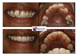 Before and after photo of a Six Month Braces case by Charlotte dentist Dr. Payet
