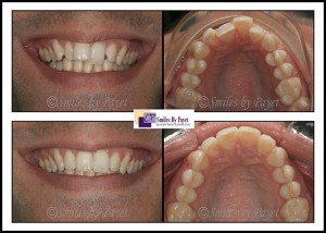 Six Month Braces before-and-after by dentist Charlotte, Matthews, Pineville, Rock Hill