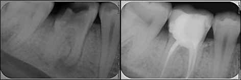 Before-after x-ray rct-crown A root canal and porcelain crown done in 1 dental visit by Charlotte dentist Dr. Payet