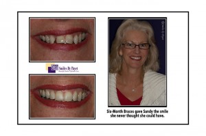 Six Month Braces before-after photos by Charlotte Matthews Pineville dentist